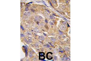 Formalin-fixed and paraffin-embedded human breast carcinoma tissue reacted with EIF4B polyclonal antibody  , which was peroxidase-conjugated to the secondary antibody, followed by DAB staining. (EIF4B anticorps  (Ser422))