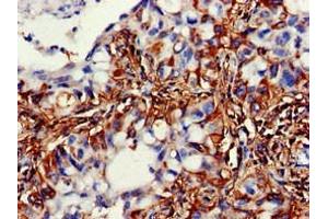 Immunohistochemistry of paraffin-embedded human lung cancer using ABIN7169541 at dilution of 1:100 (ACADSB anticorps  (AA 34-253))