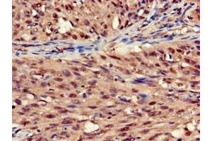Immunohistochemistry of paraffin-embedded human lung cancer using ABIN7170803 at dilution of 1:100 (STOML3 anticorps  (AA 205-291))