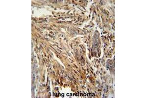 CSF2 antibody (Center) immunohistochemistry analysis in formalin fixed and paraffin embedded human lung carcinoma followed by peroxidase conjugation of the secondary antibody and DAB staining.
