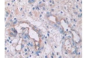 DAB staining on IHC-P; Samples: Human Glioma Tissue) (IL-33 anticorps  (AA 112-270))