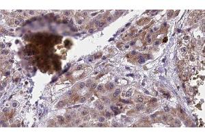 ABIN6277418 at 1/100 staining Human liver cancer tissue by IHC-P. (P2RY4 anticorps  (C-Term))