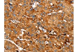 The image on the left is immunohistochemistry of paraffin-embedded Human liver cancer tissue using ABIN7130896(RNF14 Antibody) at dilution 1/20, on the right is treated with fusion protein. (RNF14 anticorps)