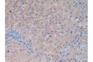 Detection of DBP in Human Liver Cancer Tissue using Polyclonal Antibody to Vitamin D Binding Protein (DBP)