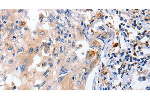 Immunohistochemistry of paraffin-embedded Human cervical cancer using IL18 Polyclonal Antibody at dilution of 1:100 (IL-18 anticorps)