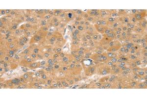 Immunohistochemistry of paraffin-embedded Human liver cancer using SNX2 Polyclonal Antibody at dilution of 1:40