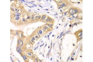 Immunohistochemistry of paraffin-embedded Human liver cancer using HAGH Polyclonal Antibody at dilution of 1:100 (40x lens). (HAGH anticorps)
