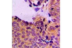Immunohistochemical analysis of PDPK1 (pS241) staining in human breast cancer formalin fixed paraffin embedded tissue section. (PDPK1 anticorps  (pSer241))