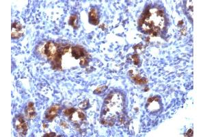 Formalin-fixed, paraffin-embedded human Gastric Carcinoma stained with MUC3 Monoclonal Antibody (MUC3/1154). (MUC3A anticorps)