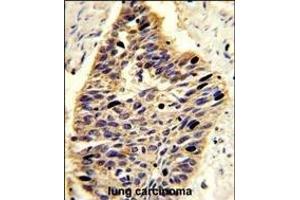 Formalin-fixed and paraffin-embedded human lung carcinoma reacted with G4 Antibody (Center ), which was peroxidase-conjugated to the secondary antibody, followed by DAB staining.
