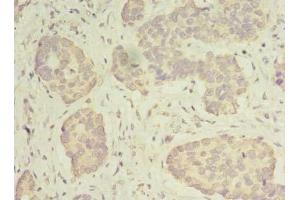 Immunohistochemistry of paraffin-embedded human gastric cancer using ABIN7142267 at dilution of 1:100