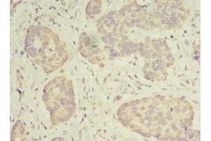 Immunohistochemistry of paraffin-embedded human gastric cancer using ABIN7142267 at dilution of 1:100 (MRPS31 anticorps  (AA 66-395))
