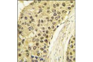 Formalin-fixed and paraffin-embedded human breast carcinoma tissue reacted with CCNA2 antibody (C-term), which was peroxidase-conjugated to the secondary antibody, followed by DAB staining. (Cyclin A anticorps  (C-Term))