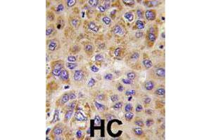Formalin-fixed and paraffin-embedded human hepatocellular carcinoma reacted with PFKFB1 polyclonal antibody  , which was peroxidase-conjugated to the secondary antibody, followed by DAB staining. (PFKFB1 anticorps  (Internal Region))