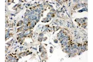 Anti- BMP5 Picoband antibody, IHC(P) IHC(P): Human Lung Cancer Tissue (BMP5 anticorps  (C-Term))