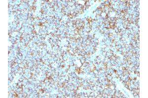 Formalin-fixed, paraffin-embedded human Ewing's Sarcoma stained with CD99 Rabbit Recombinant Monoclonal Antibody (MIC2/1495R). (Recombinant CD99 anticorps)