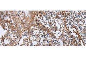 Immunohistochemistry of paraffin-embedded Human tonsil tissue using BLVRB Polyclonal Antibody at dilution of 1:65(x200) (BLVRB anticorps)