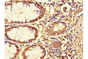 Immunohistochemistry of paraffin-embedded human colon cancer using ABIN7144761 at dilution of 1:100