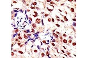 IHC analysis of FFPE human breast carcinoma tissue stained with the PRMT2 antibody (PRMT2 anticorps  (AA 22-53))