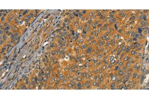 Immunohistochemistry of paraffin-embedded Human cervical cancer tissue using CIB1 Polyclonal Antibody at dilution 1:30 (CIB1 anticorps)