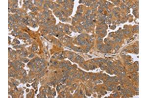 The image on the left is immunohistochemistry of paraffin-embedded Human ovarian cancer tissue using ABIN7191664(NMT1 Antibody) at dilution 1/45, on the right is treated with synthetic peptide. (NMT1 anticorps)