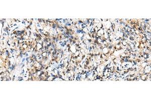 Immunohistochemistry of paraffin-embedded Human lung cancer tissue using NUDT18 Polyclonal Antibody at dilution of 1:40(x200) (NUDT18 anticorps)