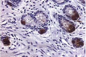 Paraffin embedded human colon cancer tissue was stained with Mouse Anti-Human MMP-9-UNLB, DAB, and hematoxylin.