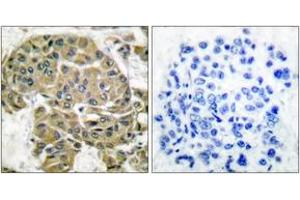 Immunohistochemistry analysis of paraffin-embedded human breast carcinoma tissue, using Mammaglobin B Antibody. (SCGB2A1 anticorps  (AA 10-59))