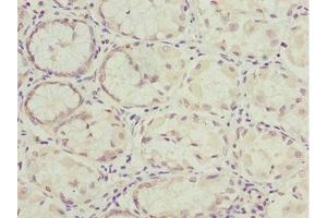 Immunohistochemistry of paraffin-embedded human gastric cancer using ABIN7161726 at dilution of 1:100