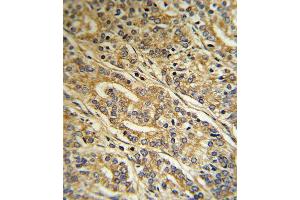 Formalin-fixed and paraffin-embedded human Prostate carcinoma reacted with ACOT8 Antibody (C-term), which was peroxidase-conjugated to the secondary antibody, followed by DAB staining. (ACOT8 anticorps  (C-Term))