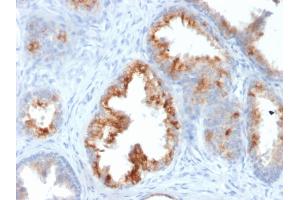 Formalin-fixed, paraffin-embedded human Prostate Carcinoma stained with AMACR / p504S Mouse Monoclonal Antibody (AMACR/1864).