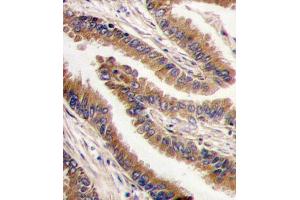 Formalin-fixed and paraffin-embedded human lung carcinoma tissue reacted with PRKX antibody , which was peroxidase-conjugated to the secondary antibody, followed by DAB staining.