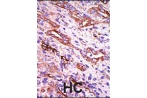 Formalin-fixed and paraffin-embedded human cancer tissue reacted with the primary antibody, which was peroxidase-conjugated to the secondary antibody, followed by DAB staining.