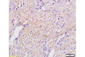 Formalin-fixed and paraffin embedded human endometrial carcinoma labeled with Anti TAP2/ABCB3 Polyclonal Antibody,Unconjugated (ABIN680123) at 1:200 followed by conjugation to the secondary antibody and DAB staining. (TAP2 anticorps  (AA 451-550))