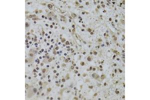 Immunohistochemistry of paraffin-embedded human liver cancer using INTS6 Antibody (ABIN2563455) at dilution of 1:100 (40x lens). (INTS6 anticorps)