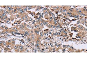 Immunohistochemistry of paraffin-embedded Human liver cancer using MAGEA3 Polyclonal Antibody at dilution of 1:50 (MAGEA3 anticorps)