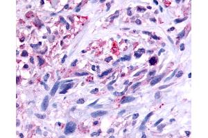 Anti-GPR45 antibody IHC of human Brain, Glioblastoma. (GPR45 anticorps  (C-Term))