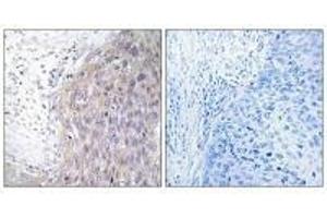 Immunohistochemistry analysis of paraffin-embedded human cervix carcinoma tissue using POLG2 antibody. (POLG2 anticorps)