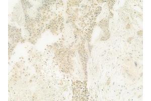 ABIN6264927 and ABIN6278743 at 1/100 staining human breast carcinoma by IHC-P. (SART3 anticorps  (C-Term))