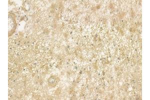 ABIN6263704 and ABIN6277161 at 1/100 staining human astrocytoma by IHC-P.