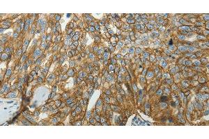 Immunohistochemistry of paraffin-embedded Human ovarian cancer tissue using SLC16A1 Polyclonal Antibody at dilution 1:50 (SLC16A1 anticorps)
