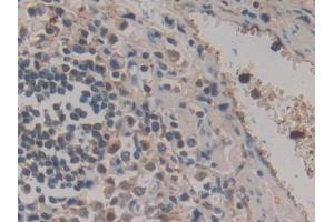 Detection of HPR in Human Stomach cancer Tissue using Polyclonal Antibody to Haptoglobin Related Protein (HPR)