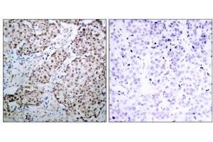 Immunohistochemical analysis of paraffin-embedded human breast carcinoma tissue using p53 (phospho- Ser315) antibody (E011100). (p53 anticorps  (pSer315))