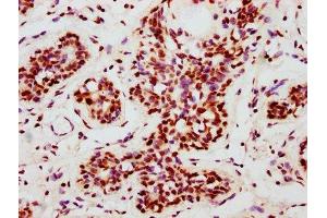 IHC image of ABIN7127694 diluted at 1:100 and staining in paraffin-embedded human breast cancer performed on a Leica BondTM system.
