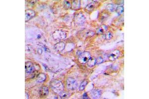 Immunohistochemical analysis of Caspase 3 staining in human lung cancer formalin fixed paraffin embedded tissue section. (Caspase 3 anticorps  (Center))