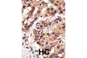 Formalin-fixed and paraffin-embedded human hepatocellular carcinoma tissue reacted with MLLT3 polyclonal antibody  , which was peroxidase-conjugated to the secondary antibody, followed by AEC staining. (AF9 anticorps  (C-Term))