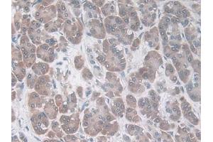 IHC-P analysis of Human Breast cancer Tissue, with DAB staining. (CCL20 anticorps  (AA 27-96))