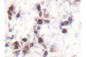 Immunohistochemistry analyzes of hnRNP C1/2 antibody in paraffin-embedded human breast carcinoma tissue. (HNRNPC anticorps)