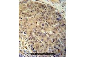 BUD13 antibody (C-term) immunohistochemistry analysis in formalin fixed and paraffin embedded human hepatocarcinoma followed by peroxidase conjugation of the secondary antibody and DAB staining. (BUD13 anticorps  (C-Term))