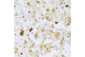Immunohistochemistry of paraffin-embedded human brain astrocytoma using FCN1 Antibody.